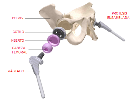 Componentes de prótesis artificial